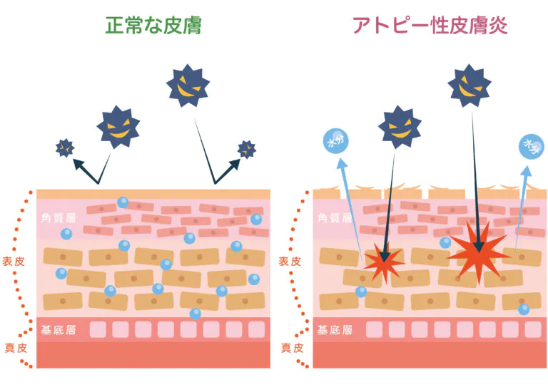 アトピー性皮膚炎とは？