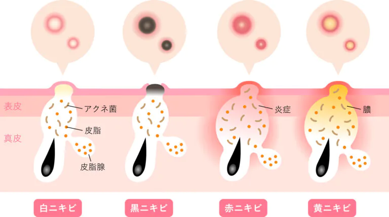 ニキビでお悩みの方へ