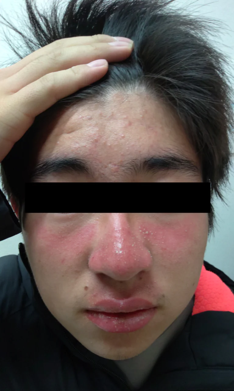 ビブラマイシンによる薬剤性光線過敏