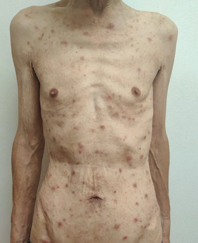 疥癬胸部