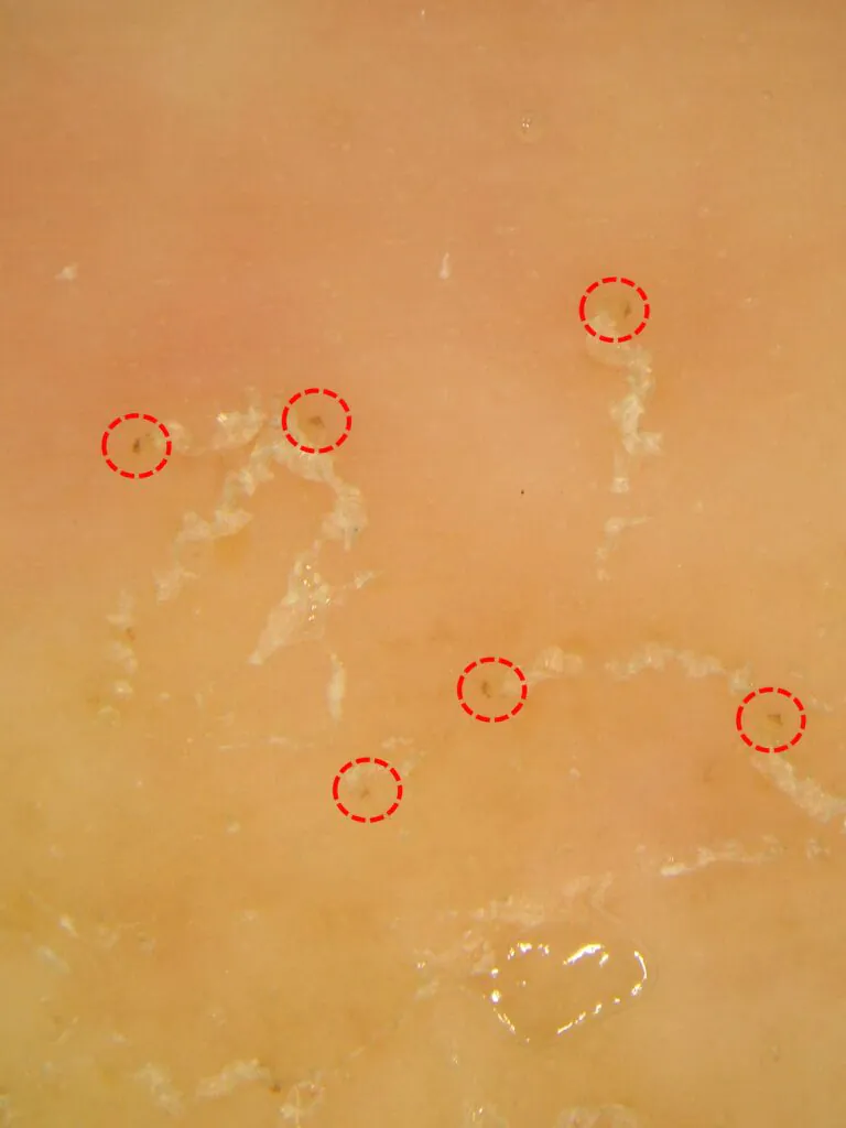 疥癬ダーモスコピー像