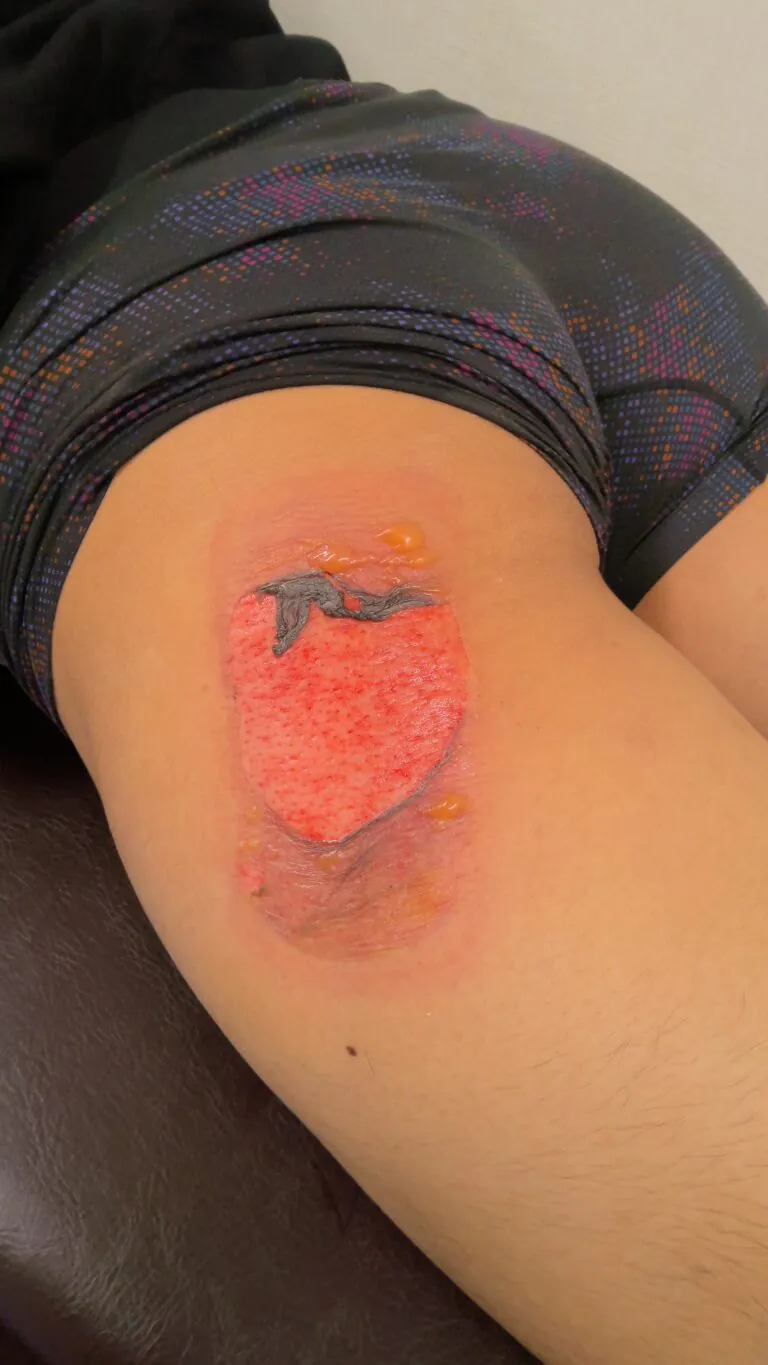 左大腿モバイルバッテリー熱傷