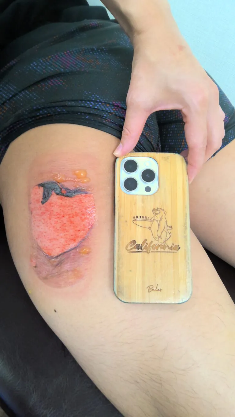 左大腿モバイルバッテリー熱傷5