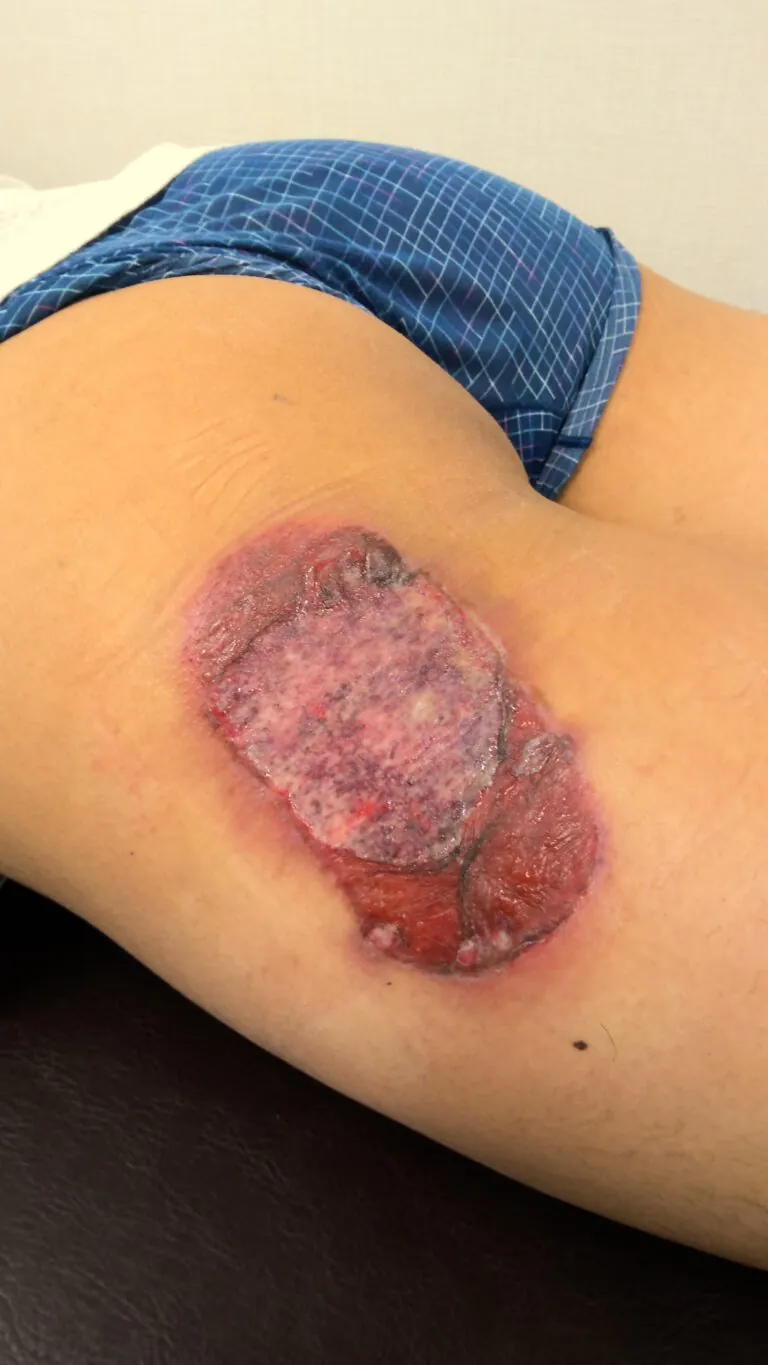 左大腿モバイルバッテリー熱傷