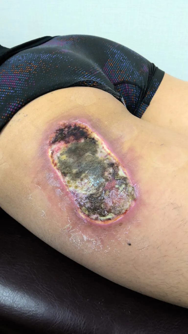 左大腿モバイルバッテリー熱傷6