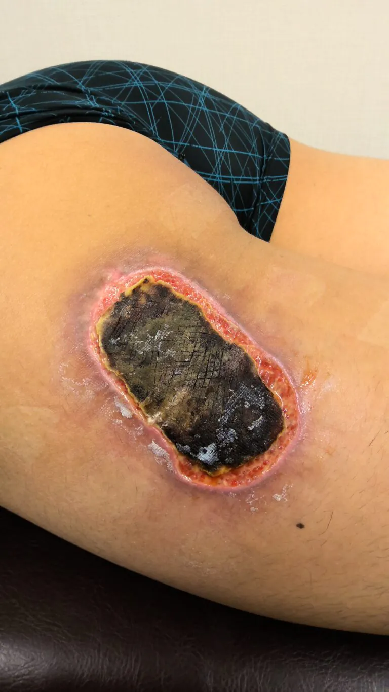 左大腿モバイルバッテリー熱傷7
