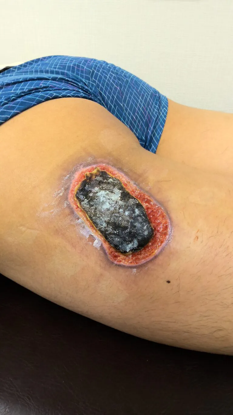 左大腿モバイルバッテリー熱傷8